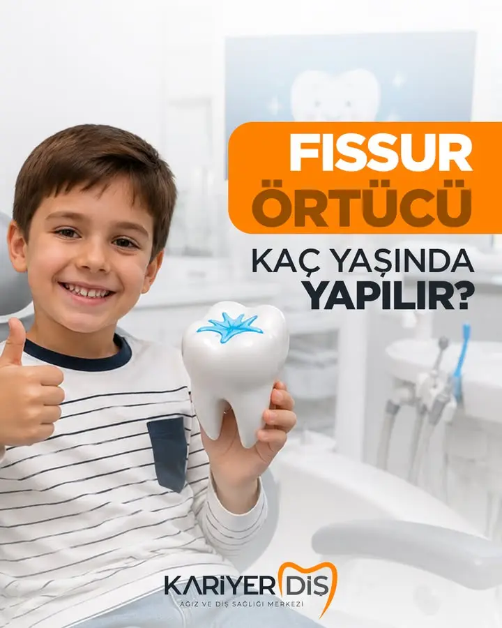 Fissür örtücü uygulaması diş sağlığında önemli