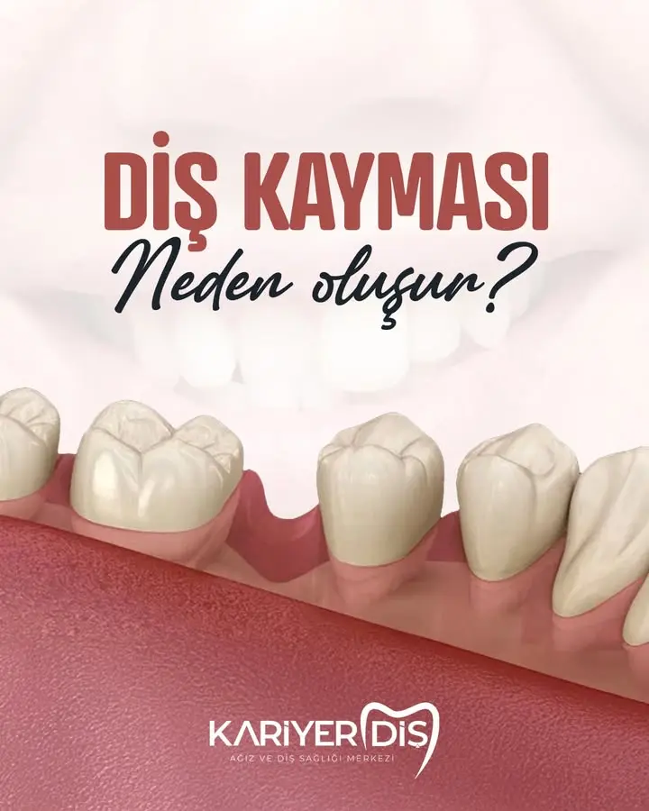 Diş Kayması Sorunu Hakkında Bilgilendirme