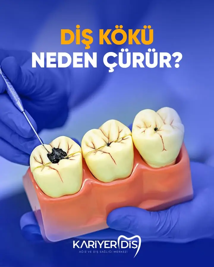 Diş kökü çürümesi nedenleri açıklandı