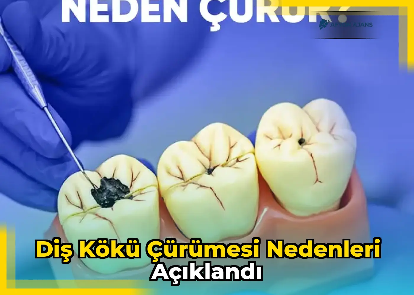 Diş kökü çürümesi nedenleri açıklandı